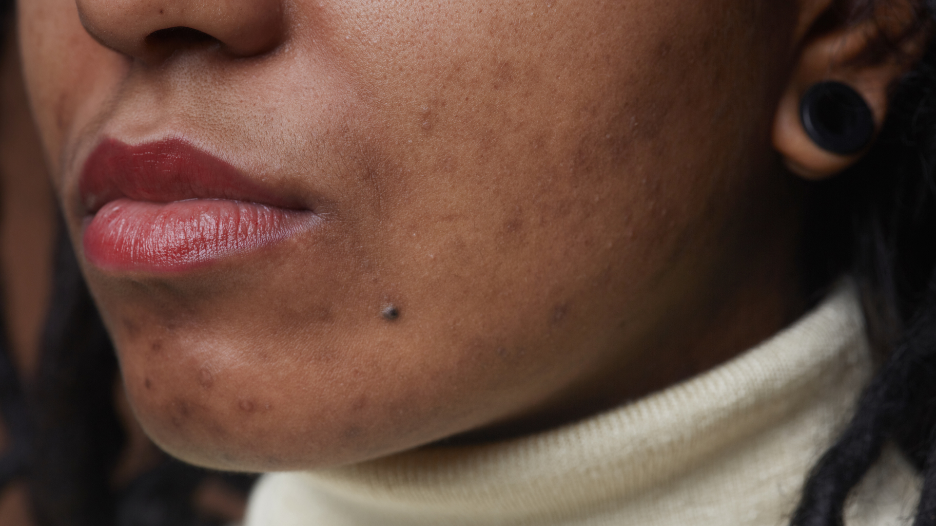 Comment reconnaître et soigner l'acné hormonale ?
